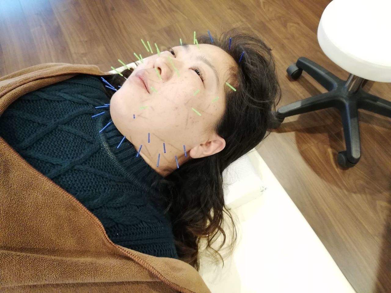 きがわ上野鍼灸院　美容鍼の施術風景7