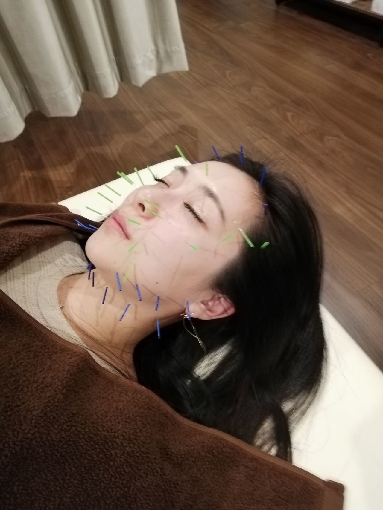 きがわ上野鍼灸院　美容鍼の施術風景3