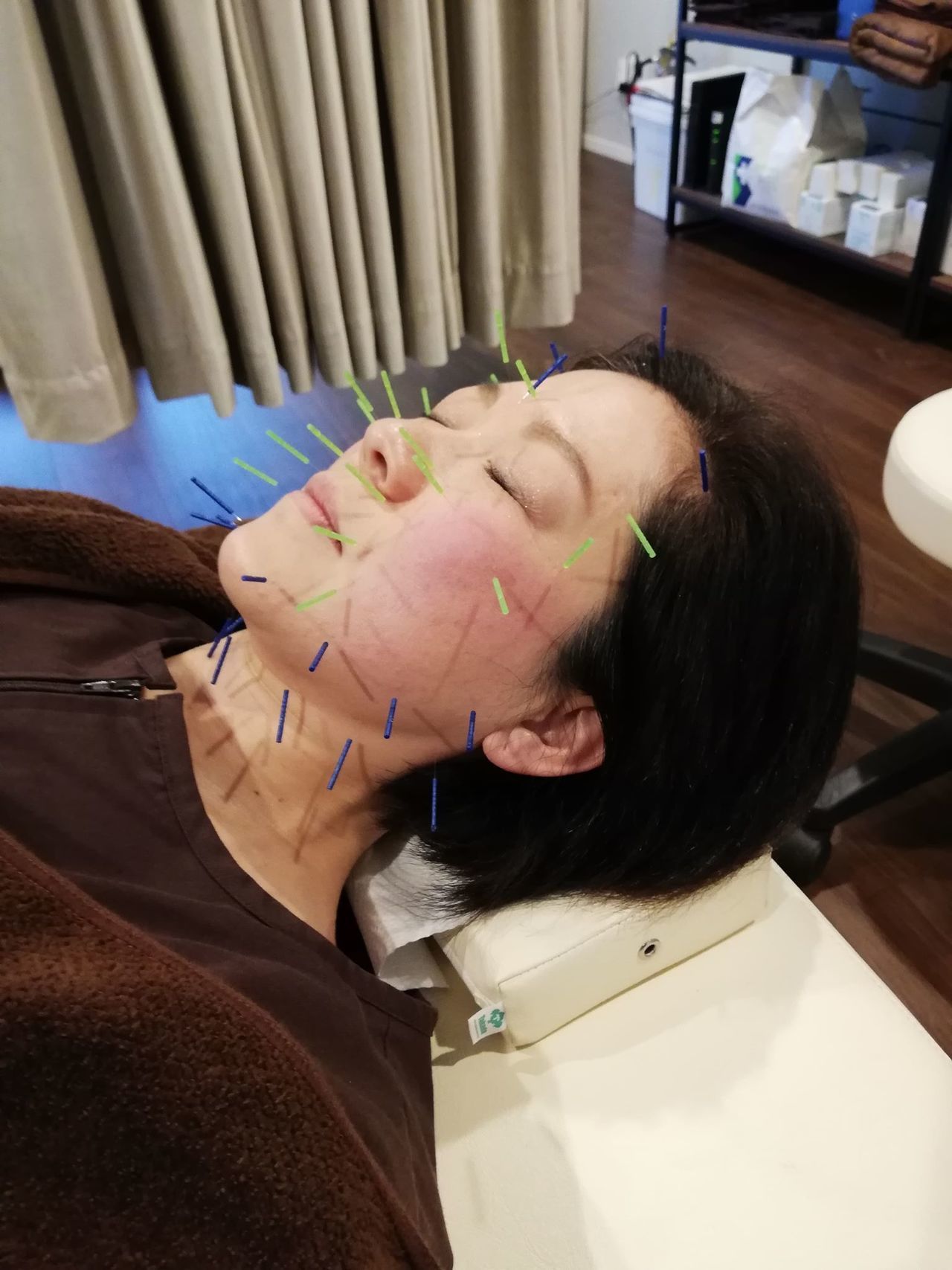きがわ上野鍼灸院　美容鍼の施術風景1