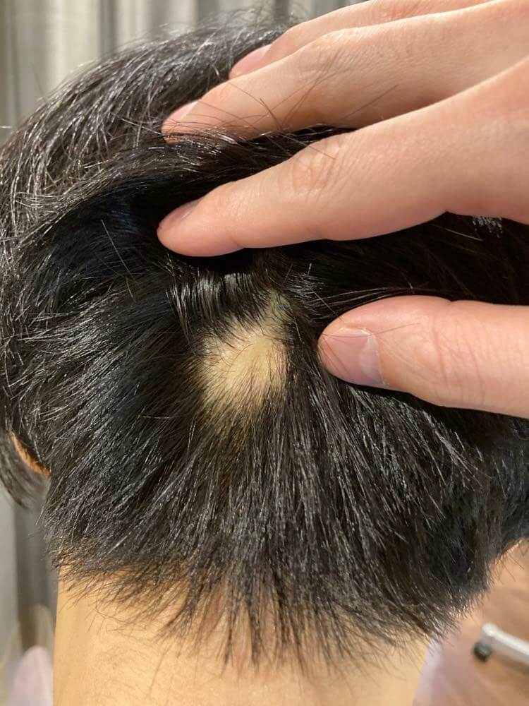 円形脱毛症・鍼灸治療後の変化：４月１３日